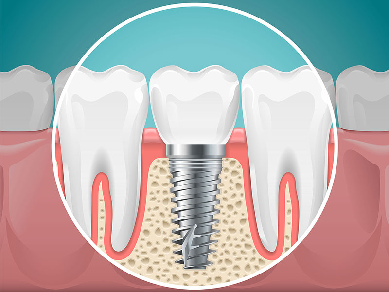 Dental Implants Inglewood